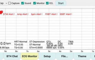ECG Monitor Interpretation Heart Rhythm PQRST Complex-10 Year Journey