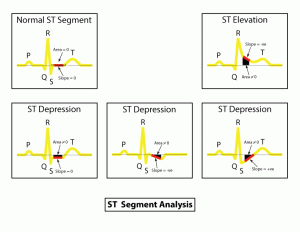  ST分析 -普通ST段 -抑鬱症ST段 -標高ST段