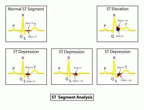 ST-Segment Analysis