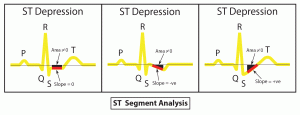 ST-抑鬱症 ST段低於基線。曲線下的面積為負。 -水平抑鬱 -下坡抑鬱 -上坡抑鬱