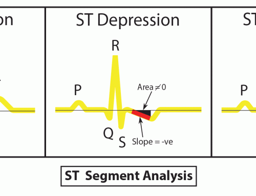 ST-Segment Analysis (Depression)