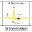 ECG Interpretation: ST-Depression