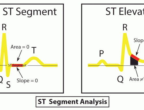 ST-Segment Analysis (Normal & Elevation)