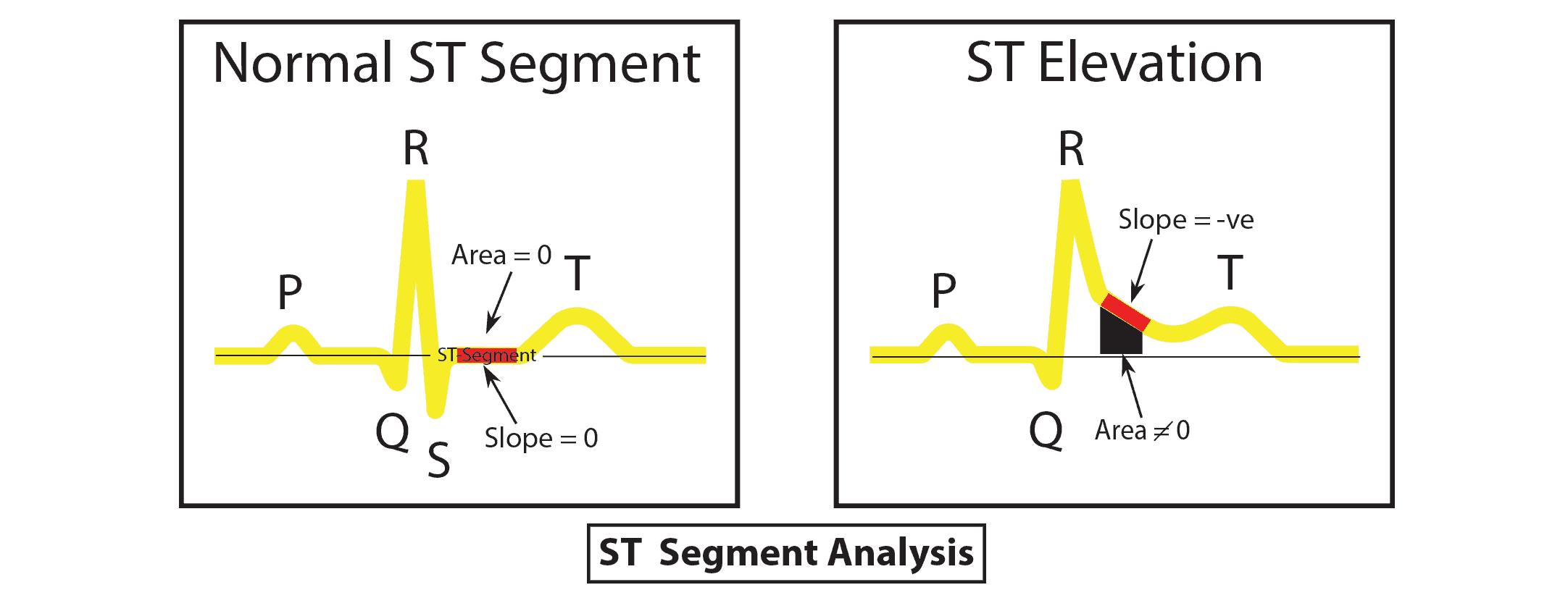 ECG Interpretation: ST-Normal-Elevation