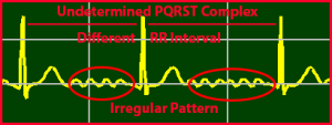 Atrial Fibrillation, Irregular Heartbeat, Undetermined-PQRST-Complex