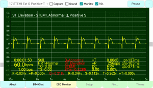 ST Elevation STEMI Extended Q-Wave Positive S-Wave Positive T-Wave