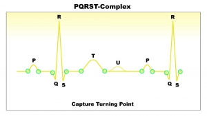 PQRST-Complex-捕獲所有轉折點