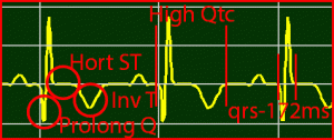 ST-Recovery Inverted T-Wave Prolong Q-Wave