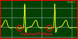 Inverted P-Wave