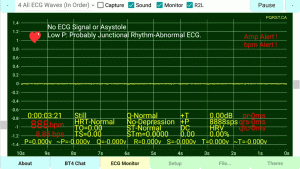 Asystole-or-NO ECG/EKG Signal