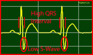 Osborn-Wave, Undetermined-PQRST-Complex