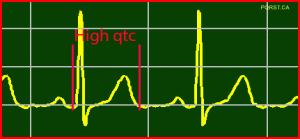 ECG/EKG Sample - High QTc Interval