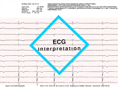 ecg Interpretation by 12 Leads ecg Machine