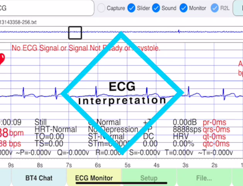 ecg Interpretation by ecgMonitor 40 Kinds of ECG/EKG Sinus Rhythm