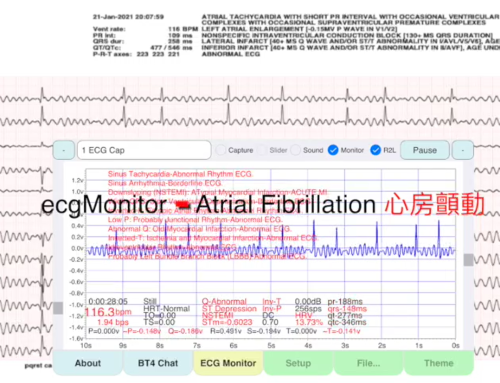 ecgMonitor Atrial Fibrillation