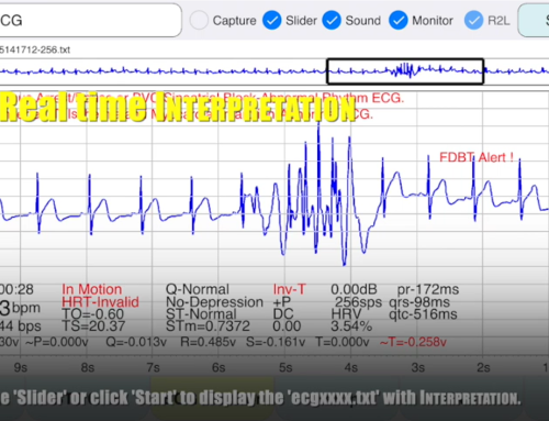 ecgMonitor Realtime Interpretation