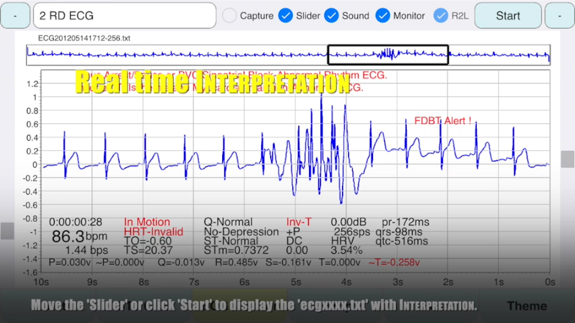 ecgMonitor Realtime Interpretation