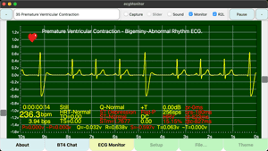 Premature Ventricular Contraction - Bigeminy 室性早搏 - 二元律