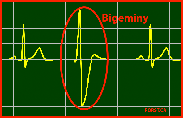 Premature Ventricular Contraction - Bigeminy 室性早搏 - 二元律