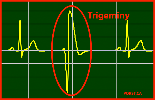 Premature Ventricular Contraction - Trigeminy 室性早搏 - 三重律