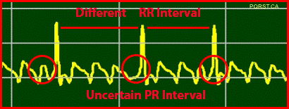 Sinus-Flutter, Undetermined-PQRST-Complex