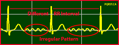 Atrial Fibrillation, Irregular Heartbeat, Undetermined-PQRST-Complex