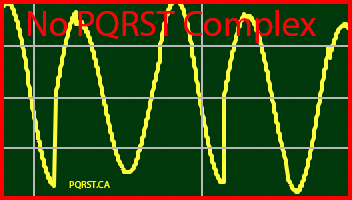 Ventricular-Tachycardia, Undetermined-PQRST-Complex