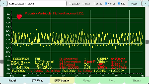 Ventricular-Flutter