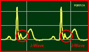 Osborn-Wave, Undetermined-PQRST-Complex