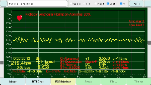 Ventricular-Fibrillation